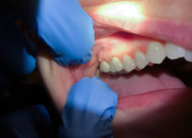 Best Broken or Cracked Tooth Emergency Dentist in Lmer Heights, PA