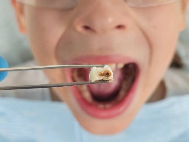 Best Emergency Dental Extractions in Lmer Heights, PA